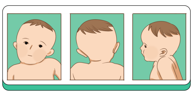宝宝五个月头有点歪头，原因、影响与应对措施
