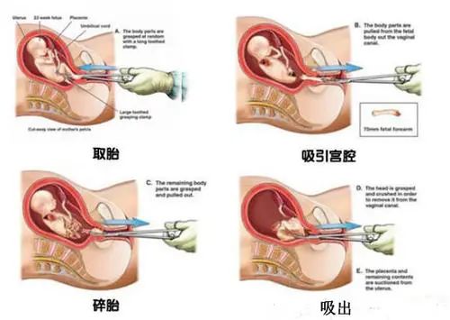 5个月无痛引产全过程详解