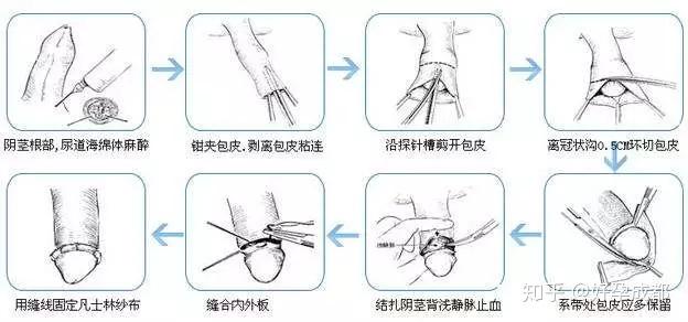 包皮手术两个月后的恢复与体验