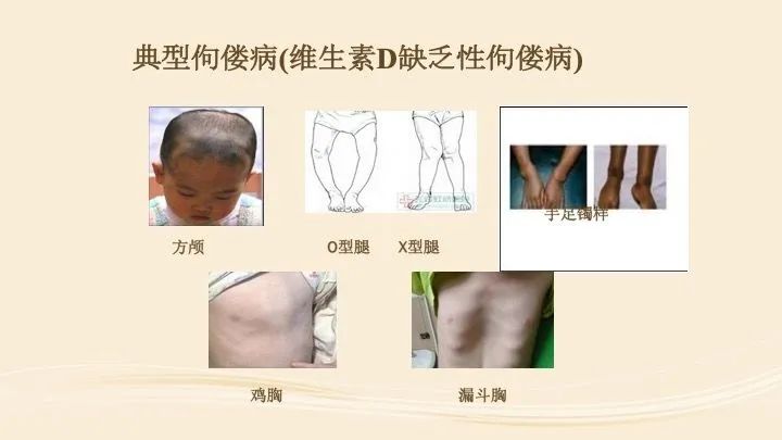 关于宝宝佝偻病的图片，了解、预防与应对