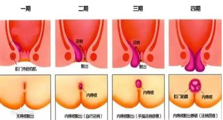 痔疮手术后两个月仍出现水肿现象，原因、处理与预防