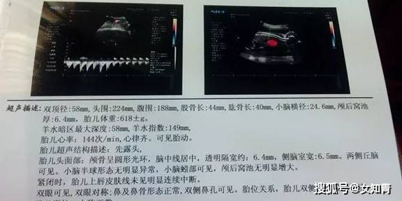 四个月能看出男女吗——关于胎儿性别鉴定的探讨